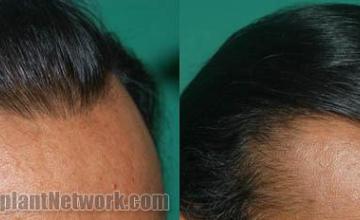 Hair restoration procedure before and after results