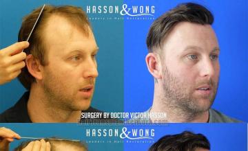 Hair transplantation procedure before and after results