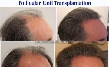 Hair transplantation procedure before and after results