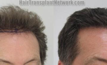 Hair restoration procedure after result images