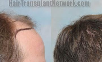 Hair transplantation procedure before and after results