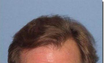 Hair restoration procedure results