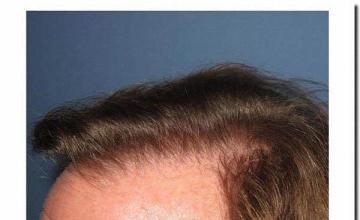 Hair restoration procedure results