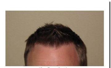 Hair restoration procedure results