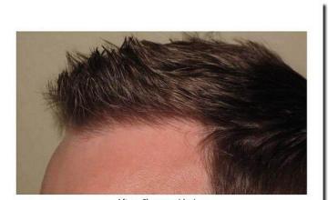 Hair restoration procedure results