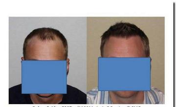 Hair restoration procedure results