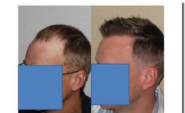 Hair restoration procedure results