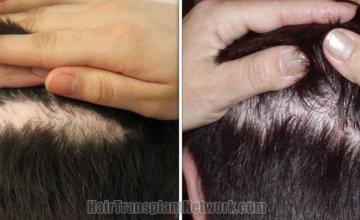 Hair transplantation surgery scar revision