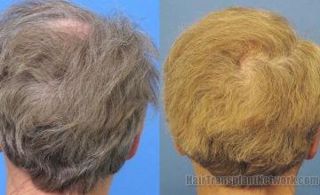 Back of patients head before and after hair transplant