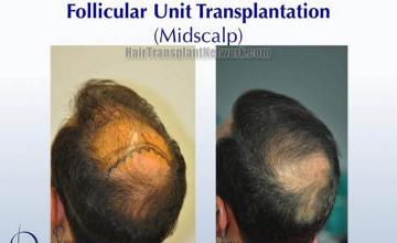 Hair transplantation surgery before and after images