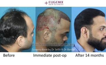 Hair restoration procedure before and after results