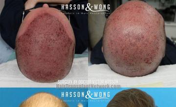 Surgical hair transplantation result photographs