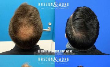 Hair transplantation procedure before and after results