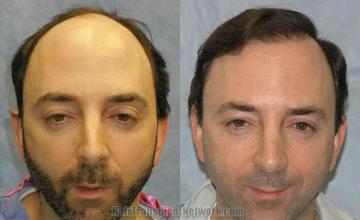 Hair transplantation surgery before and after photos