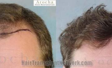 Hair transplantation surgery before and after photos