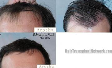 Hair restoration procedure before and after results