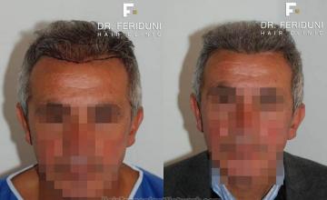 Hair restoration procedure before and after results