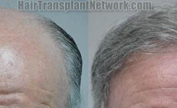 Hair restoration procedure before and after results