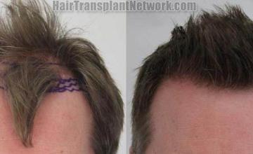 Hair transplantation surgery before and after pictures