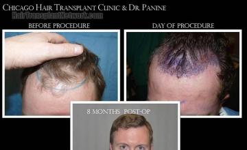 Hair restoration procedure before and after results