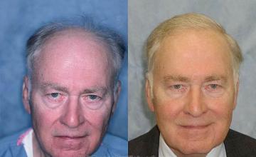 Front view - Before and after  