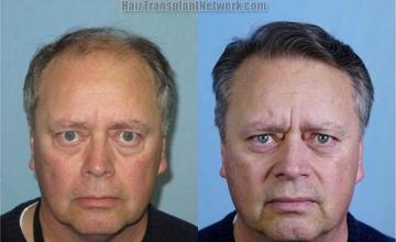 Before and after hair transplantation surgery