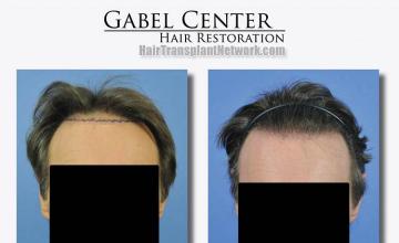 Front view - Before and after hair transplant surgery