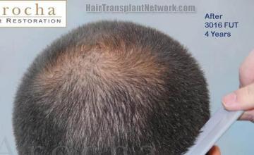 Back view four year postoperative from hair transplant