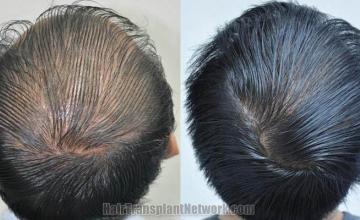 Hair restoration procedure before and after pictures