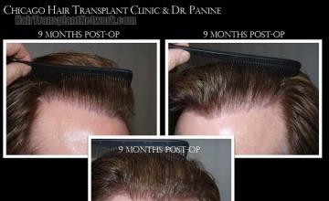 Hair restoration procedure before and after pictures