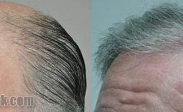 Hair transplantation surgery before and after pictures