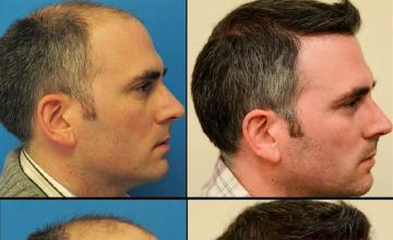 Hair transplantation surgery before and after images