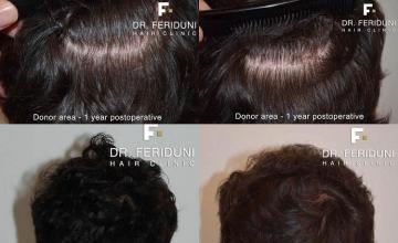 Hair transplantation surgery before and after pictures