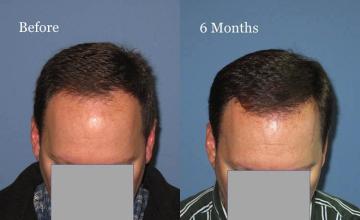 Hair transplantation surgery before and after photos