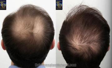 Hair restoration procedure before and after pictures