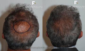 Hair restoration procedure before and after pictures