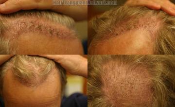 Hair restoration surgery before and after photos