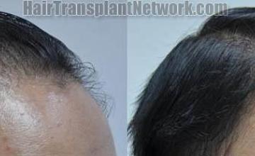 Hair transplantation surgery before and after images