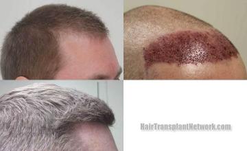 Hair restoration procedure before and after pictures