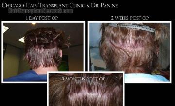 Hair transplantation surgery before and after pictures