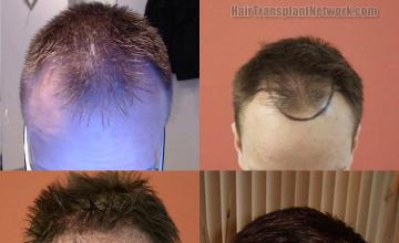 Top view before and after hair restoration results