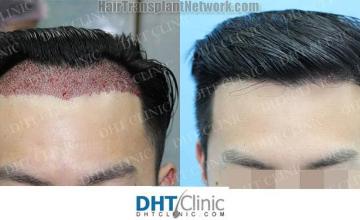 Hair transplantation surgery before and after pictures