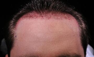 Hair transplantation surgery before and after photos