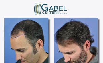 Hair transplant surgery before and after photos