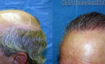 Left view before and after hair restoration procedure