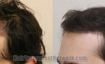 Hair restoration procedure before and after pictures