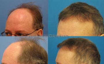 Hair transplantation surgery before and after pictures