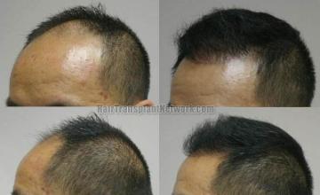 Hair restoration procedure before and after pictures