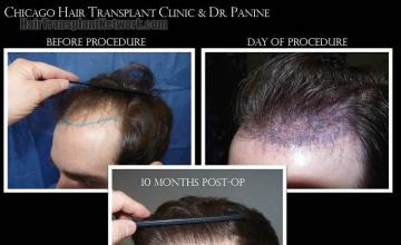 Hair transplantation surgery before and after pictures