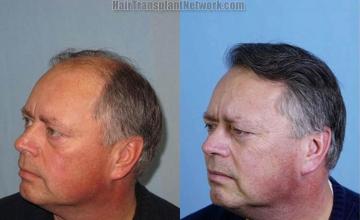 Hair transplantation surgery before and after photos